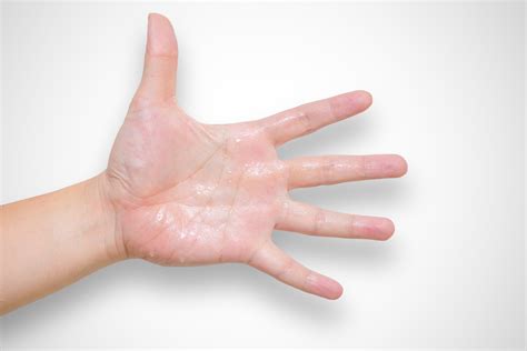 Sweating a different color -- like yellow, blue, green, or black -- is a different condition called chromhidrosis. . Describing sweaty palms